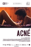 Acné